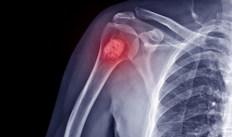 Film X-ray shoulder radiograph show Shoulder disease in arm